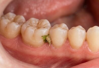 how-to-remove-food-from-teeth